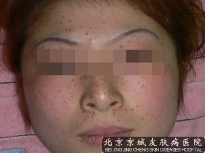 女性脸部雀斑形成的原因有哪些