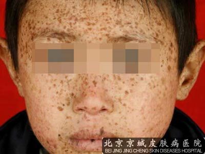 雀斑形成原因