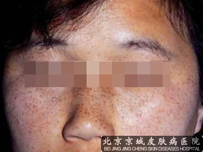 雀斑为什么会增多