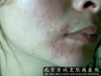 皮肤过敏护理