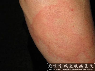 引起荨麻疹的过敏性物质有哪些