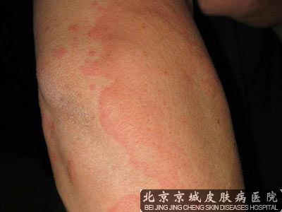 如何预防春夏时节荨麻疹