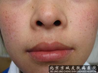 治疗雀斑的偏方有哪些