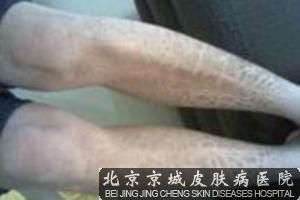 鱼鳞病的病因有哪些呢