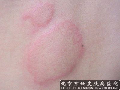荨麻疹护理要注意哪些