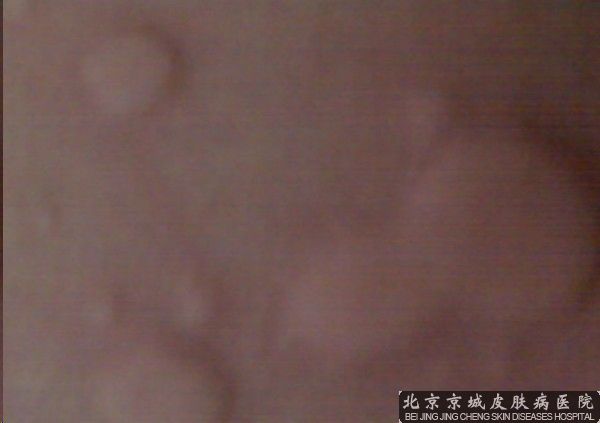 荨麻疹的保健方法有哪些
