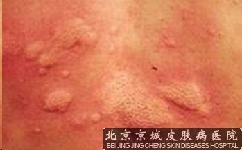 荨麻疹的危害有多少