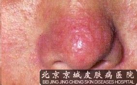 治疗酒糟鼻的方法有些什么