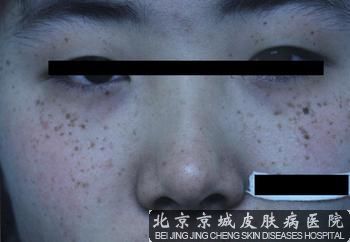 为什么会出现雀斑呢