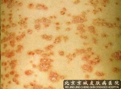 治疗神经性皮炎要注意什么