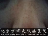 去除雀斑有什么好方法呢