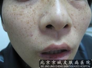 去除雀斑的小方法有哪些