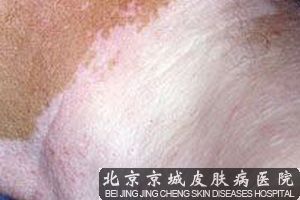 白癜风患者的保健方法有哪些