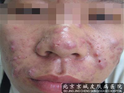 处理青春痘的误区
