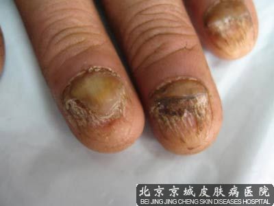 夏季如何预防灰指甲
