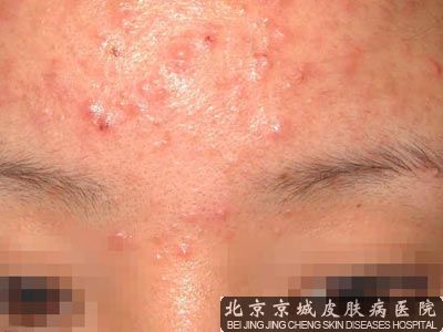 痤疮的产生原因