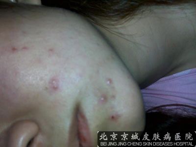痤疮引发的原因都有哪些
