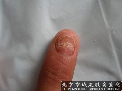 灰指甲产生原因有哪些