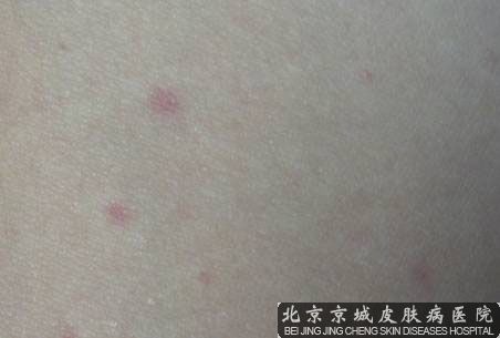 生活中怎么护理湿疹