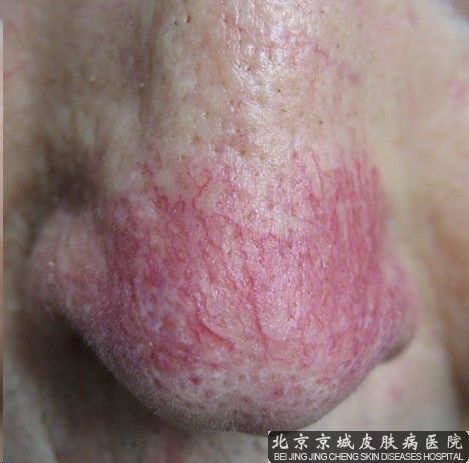 酒糟鼻怎么治