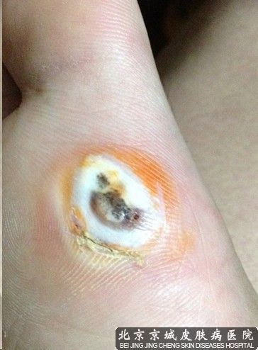 鸡眼是什么样的_北京京城皮肤病医院