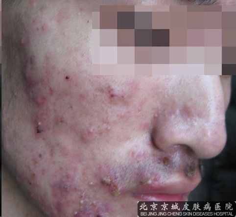 长痤疮怎么办