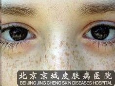 雀斑该怎样去除