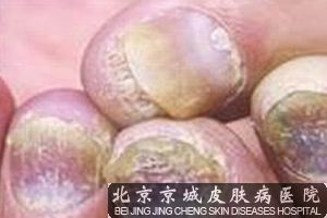 如何辨别是否得了灰指甲