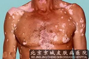 白癜风的常见症状有哪些呢