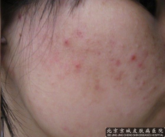 为什么脸上会长痤疮呢