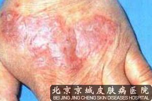 湿疹和股藓的区别