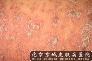 引起牛皮癣的原因是什么