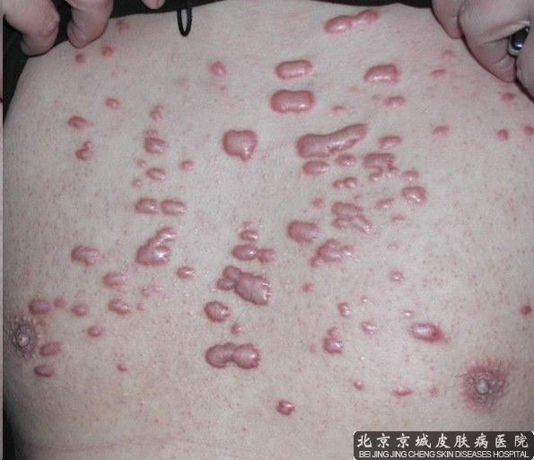 瘢痕疙瘩怎么治