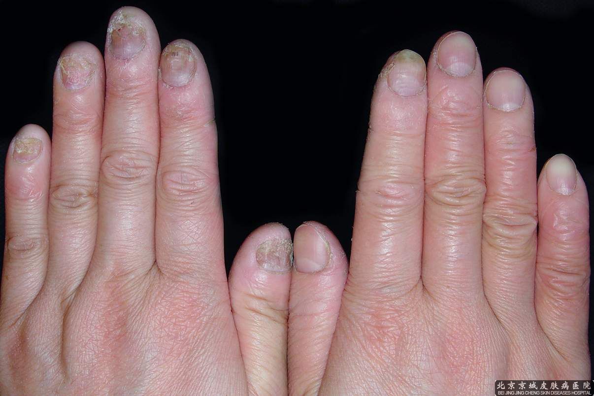 灰指甲前期症状
