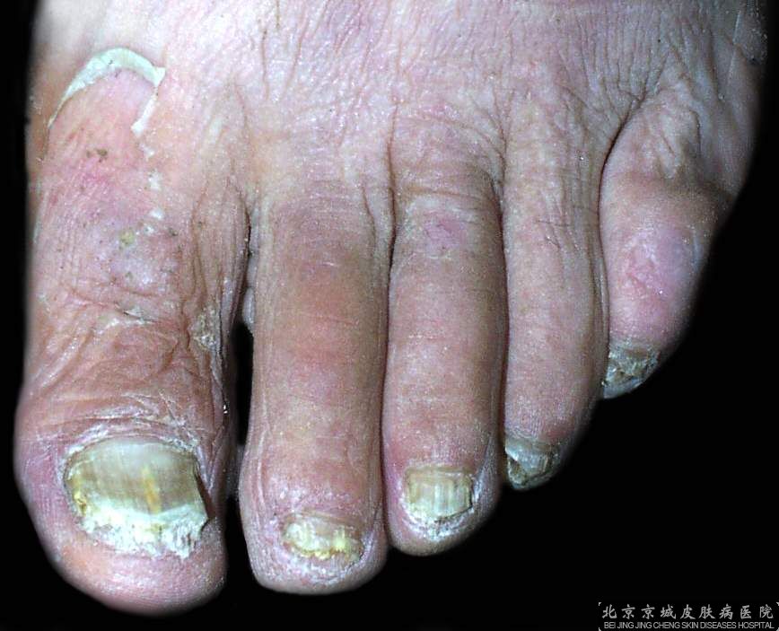 如何辨别是否得灰指甲