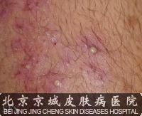 外阴长毛囊炎怎么办 治疗 毛囊炎 北京京城