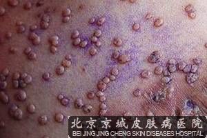 艾滋病要注意哪些方面_北京京城皮肤病医院