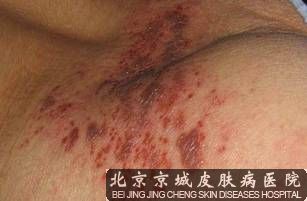 为什么同性恋者易得艾滋病