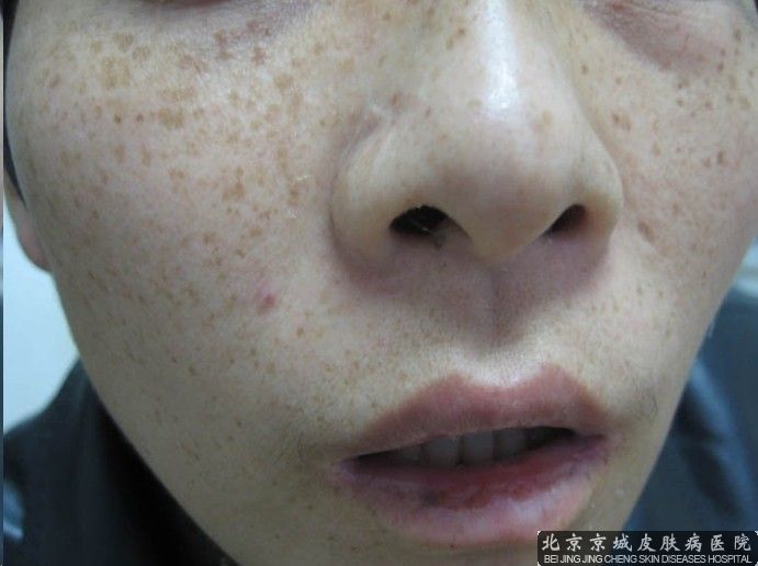 去雀斑*的方法是什么