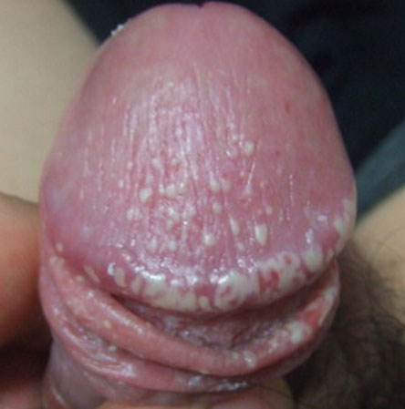 什么是珍珠疹