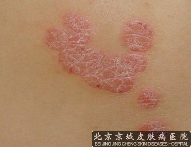 为什么会得牛皮癣