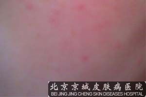 过敏性皮炎要注意什么