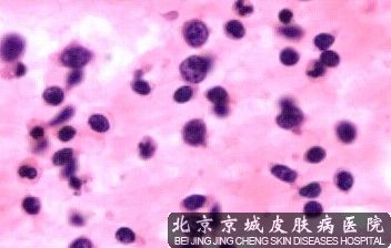 过敏性紫癜可以吃莲藕吗