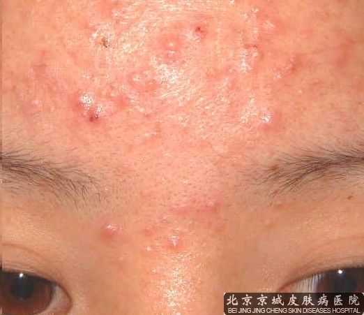 面部痤疮怎么护理好