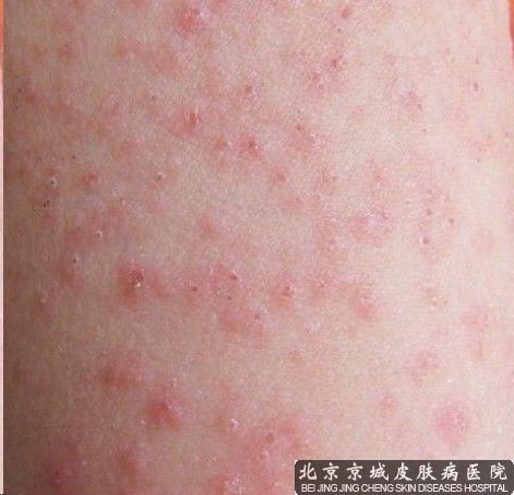 过敏性荨麻疹怎么治 治疗 荨麻疹 北京京城皮肤医院_北京皮肤病