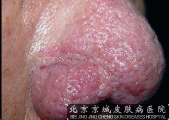 酒糟鼻有什么症状