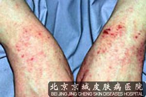 北京治疗湿疹需要多少钱