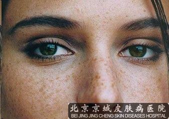 脸上雀斑怎么去除