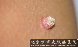 手上长寻常疣怎么办
