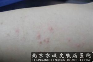 面部皮炎的发病原因是什么?